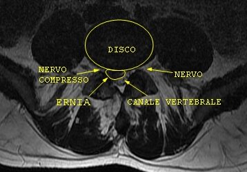 Ernia del disco e “colpo della strega”: l’approccio chiropratico Gonstead