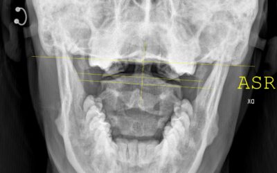 Vertigini e sbandamenti da cervicale: a volte l’orecchio non c’entra