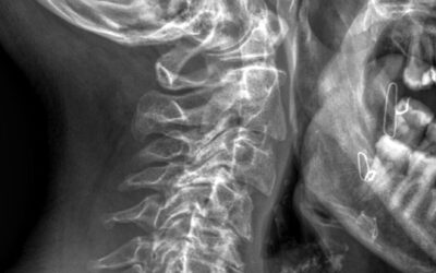 Artrosi cervicale: si può fare qualcosa? Cause, sintomi e approccio chiropratico