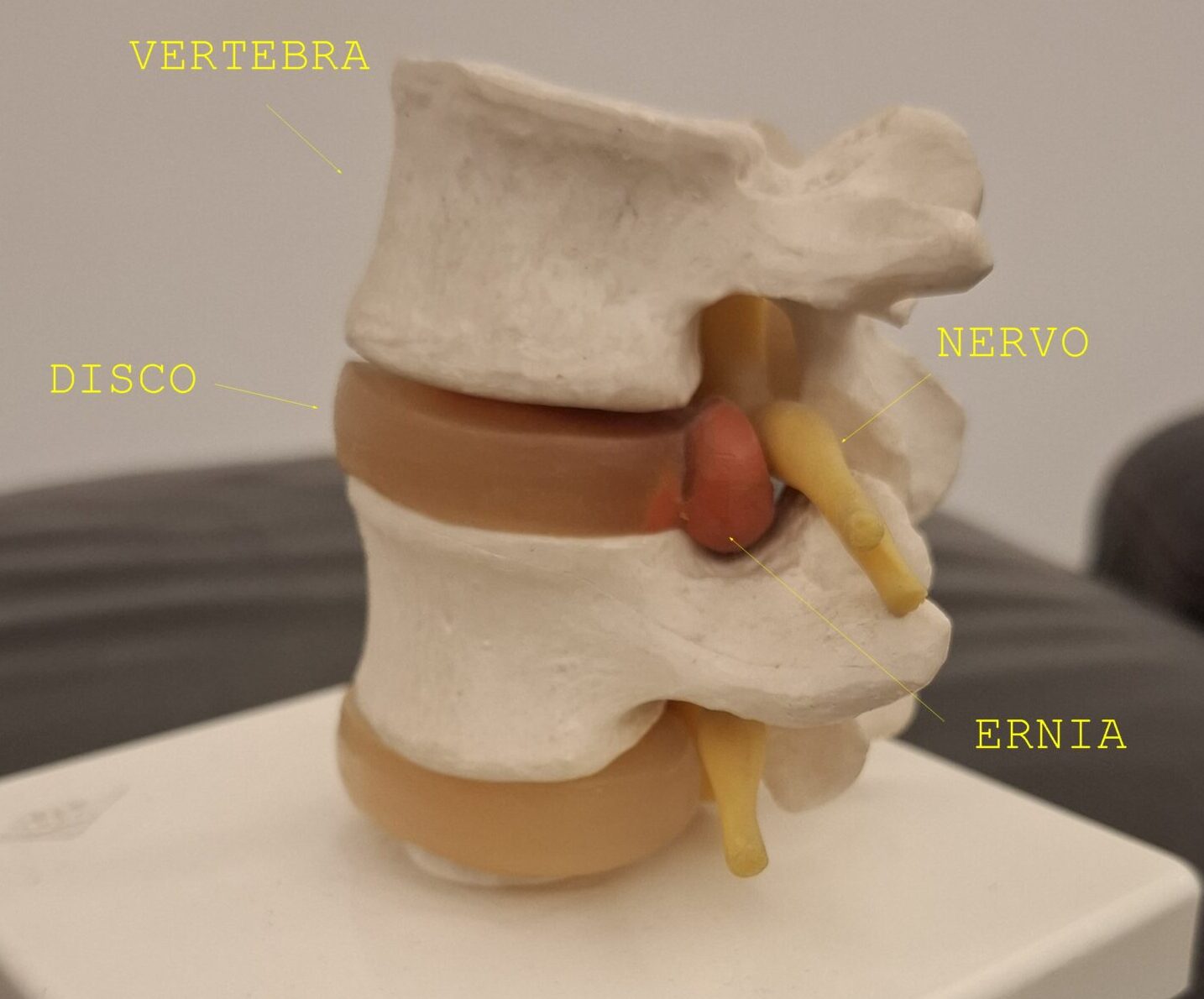 Colonna cervicale superiore e recettori posturali: come un blocco articolare genera vertigini e sbandamento