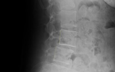 Perché il mal di schiena torna sempre? Cause e cosa fare