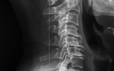 Cervicale e mal di testa: cause, meccanismi e soluzioni