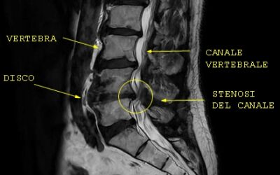 Dolore a entrambe le gambe mentre cammini?Potrebbe essere stenosi lombare? scopriamo cos’é e cosa si puó fare
