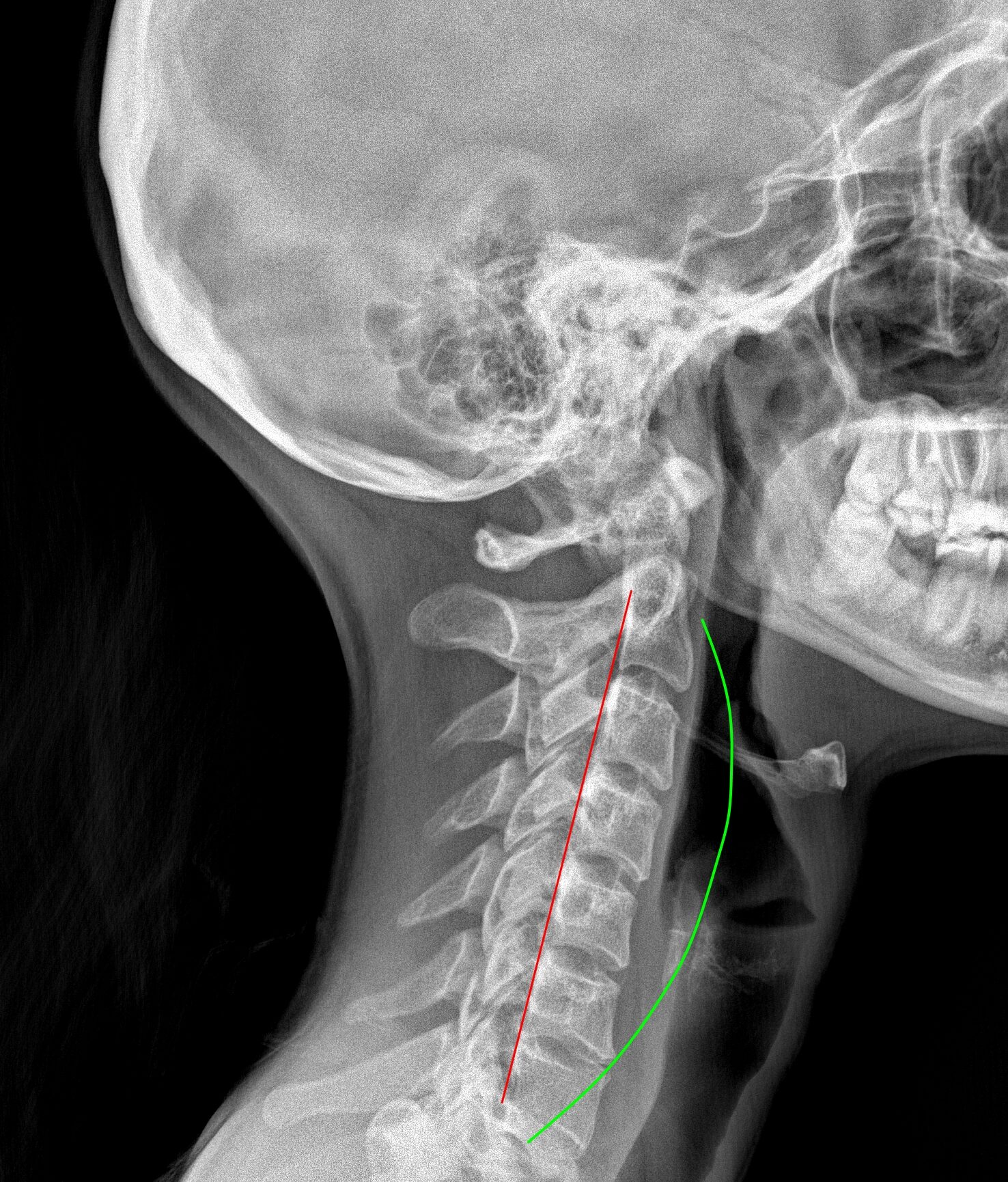 Colonna lombare in posizione seduta alla scrivania: appiattimento della curva e pressione sui dischi intervertebrali